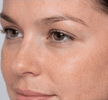 After fractional