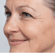 Before brow lift
