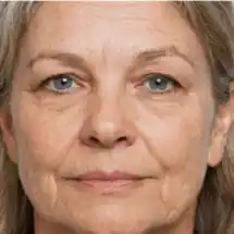 Before HydraFacial