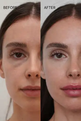 Miami Cheek Fillers
Lifted midface, sculpted cheekbones - smooth natural results after 2 weeks