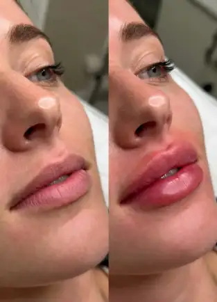 Miami Lip Fillers
Natural volume, defined cupid’s bow - smooth natural results after 2 weeks