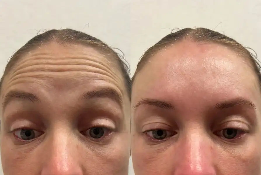 Botox forehead lines Botox Los Angeles — before and after smooth natural results