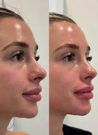 JMiami awline Fillers
Lifted midface, sculpted cheekbones - smooth natural results after 2 weeks