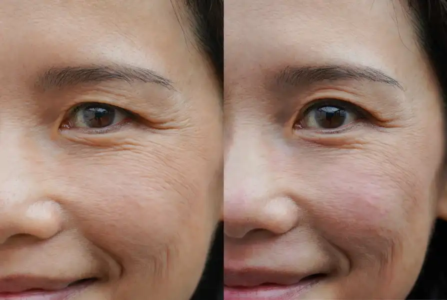 Botox crow's feet Botox Los Angeles — before and after refreshed eye area